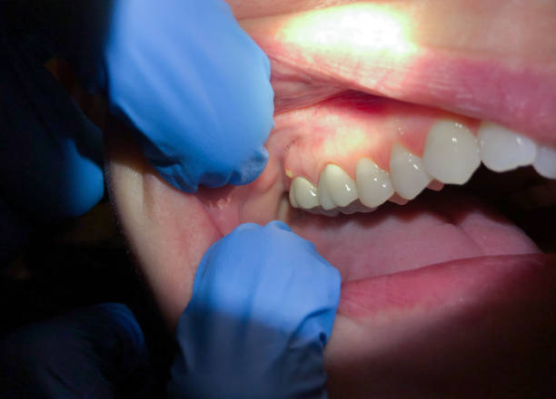 Best Dentist for Tooth Abscess  in Port Washington, WI
